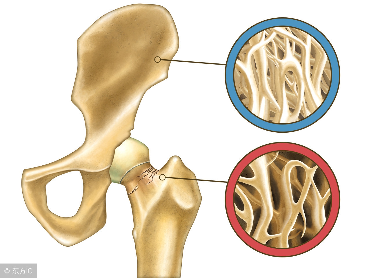 不要抱有侥幸心理，老年人的骨质疏松一定要治疗吗？