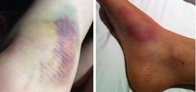 治疗关节炎的日本进口药,日本治疗创伤性关节炎