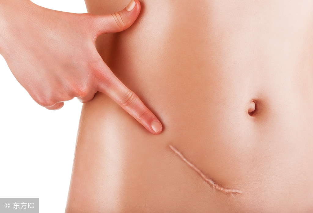 无痛肠胃镜切除息肉后怎么护理,切肠息肉疼吗