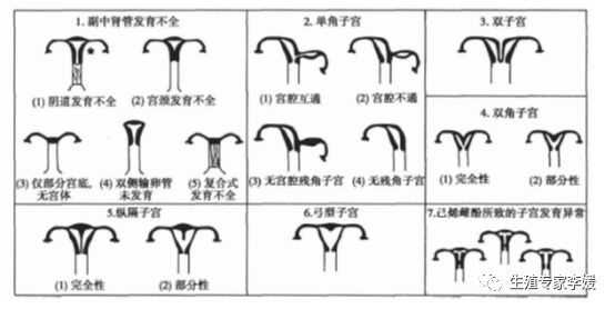 子宫畸形怀孕的可能性排序,为什么医生觉得畸形子宫难怀孕