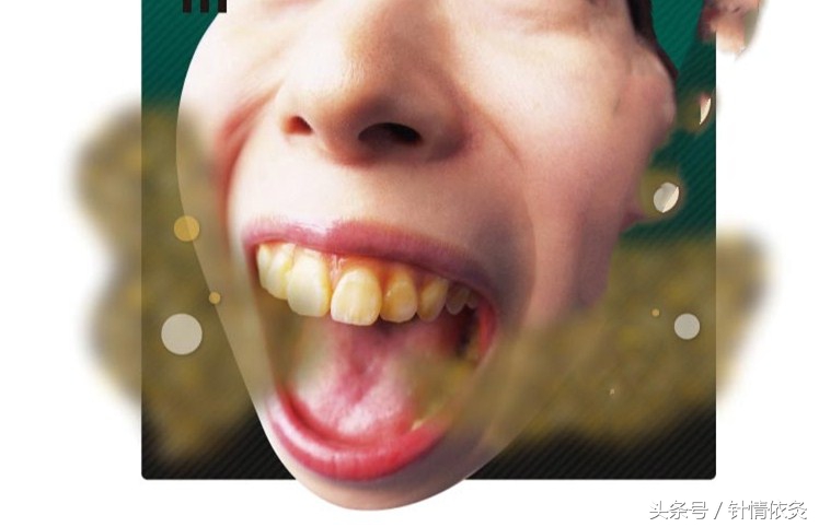 口苦口臭针灸什么穴位,刘红云治疗口臭针灸视频