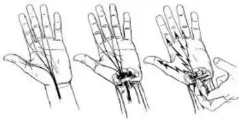 手麻、无力、肌肉萎缩？——你可能得了腕管综合征