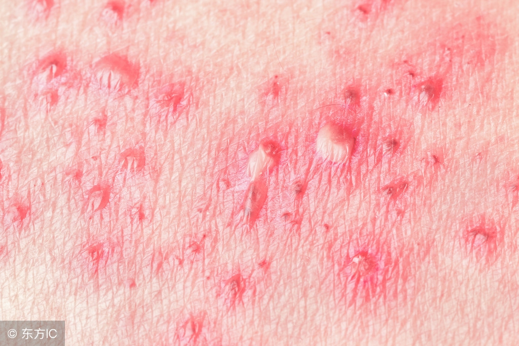 得了生殖器疱疹怎么治疗彻底有效,得了生殖器疱疹怎么治疗效果好