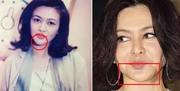 下巴填充和假体植入哪个好,下巴填充膨体跟硅胶哪个更好