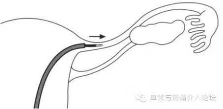 输卵管臭氧介入治疗和造影剂,介入治疗输卵管堵塞需要打麻药嘛