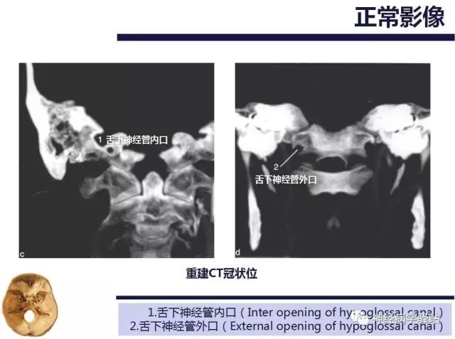 舌下神经和舌咽神经的解剖图,颊神经舌神经解剖图