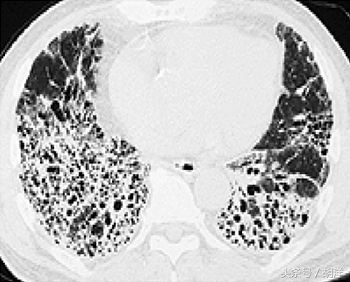 靶向药治疗肿瘤效果好，但副作用到底有多大？医生终于说了实话！
