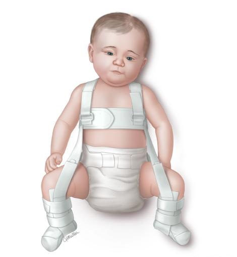 小孩臀线不对称怎么办,小孩臀纹不对称