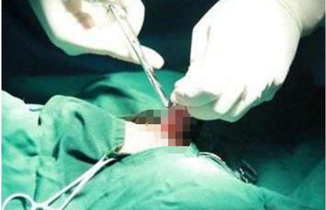 女生产后上环,女子取环6年后去医院取