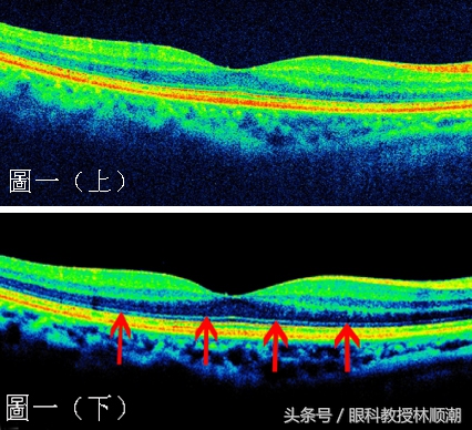 黄斑变性是致盲率非常高的眼病吗,近视性黄斑劈裂图片