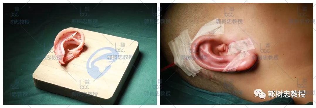 小耳病是什么,小耳症的最佳治疗方法