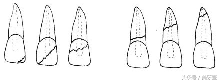 牙齿骨折有什么特征,牙齿骨折怎么修复