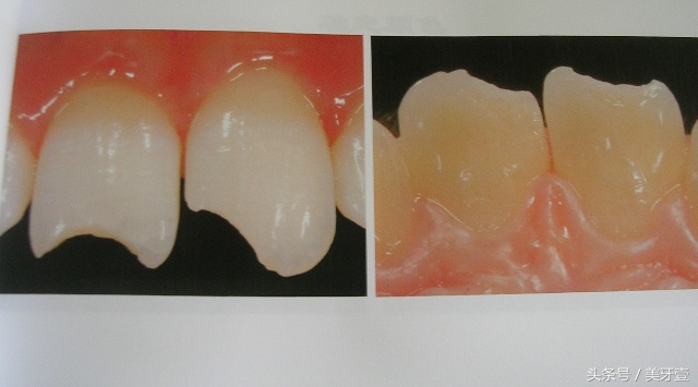 牙齿骨折有什么特征,牙齿骨折怎么修复