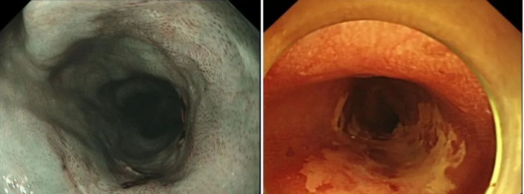 早期食管癌的病变范围是,早期食管癌手术费用多少