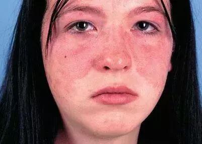 赛琳娜有系统性红斑狼疮,系统性红斑狼疮明星赛琳娜