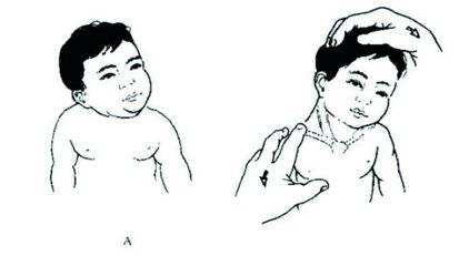 小儿斜颈的原因及治疗方法,小儿斜颈手术治疗时机