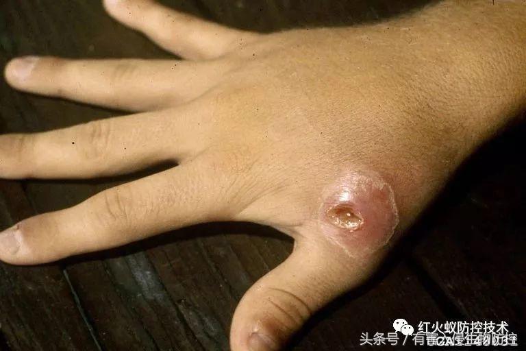 被红火蚁咬的治疗方法,被红火蚁咬后怎么处理偏方