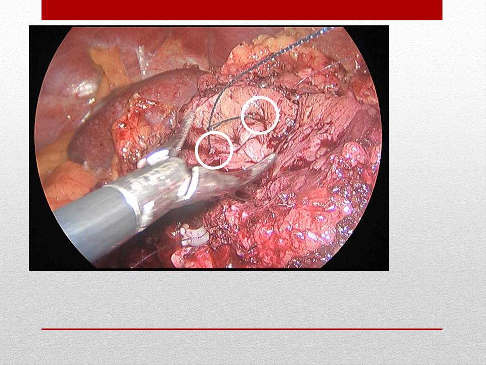 「图文+语音」刘明|泌尿外科腹腔镜手术并发症的术中及术后处理