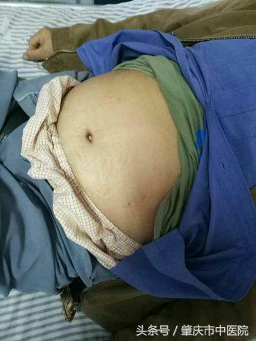 中医治疗老年人水肿的方法,肾病患者水肿久治不消怎么办