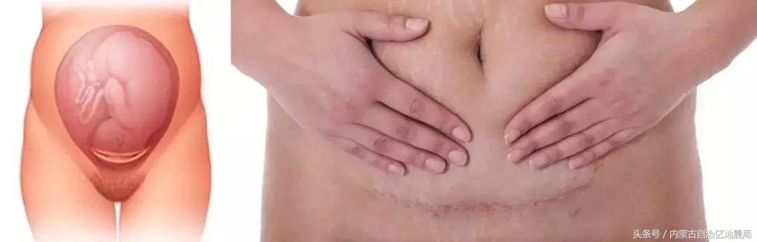 剖宫产还是顺产到底该如何选择,剖宫产好还是剖腹产好