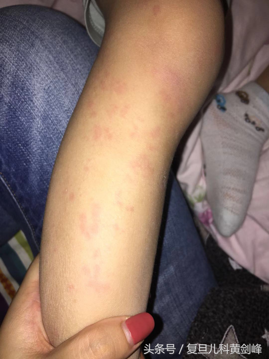 宝宝风疹块怎么引起的,宝宝身上起风疹块原因