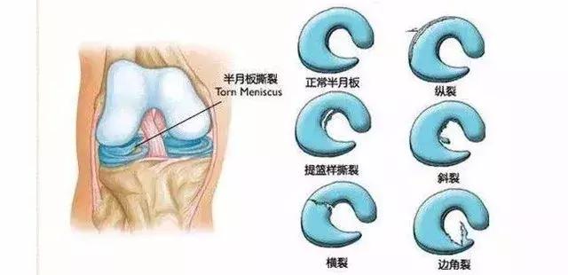 询问半月板损伤有什么特效药吗,半月板二级损伤医生说没事