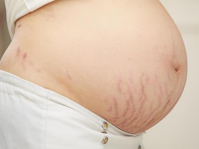 孕妇怎么防止妊娠纹,怎么防止孕期妊娠纹