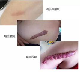 瘢痕疙瘩可以直接割下来吗,胸口瘢痕疙瘩最新治疗方法