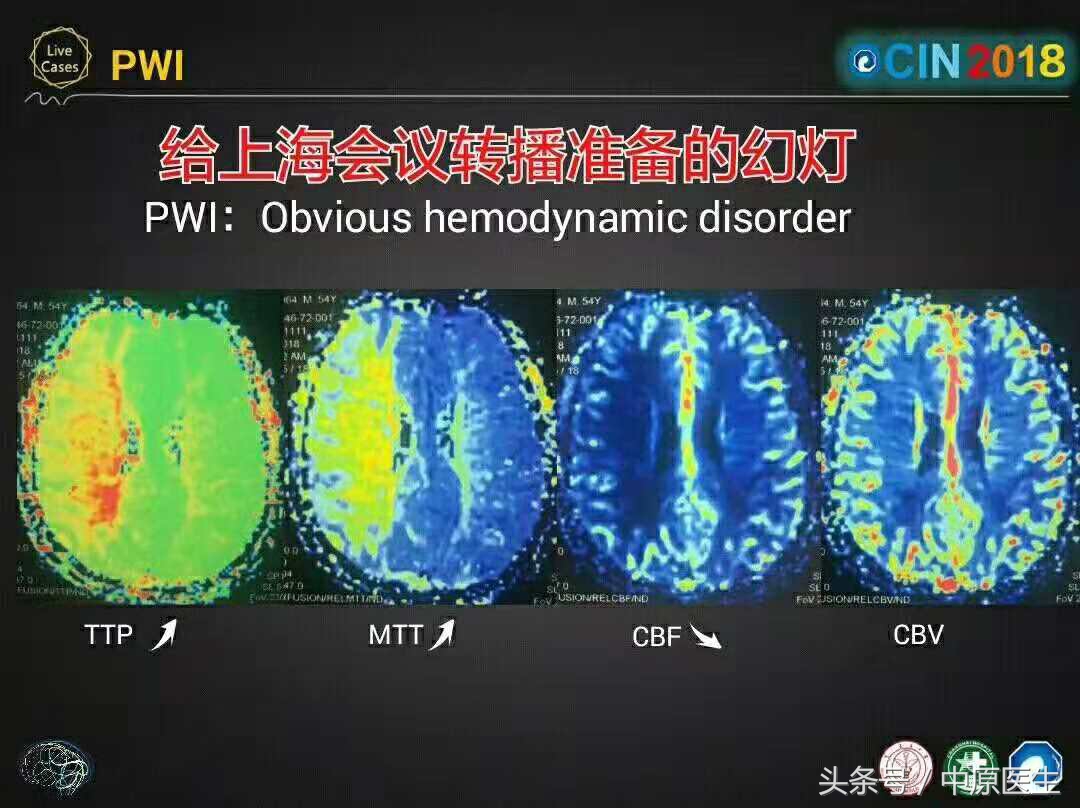 53岁男子脑梗急救室抢救真实纪实,脑动脉闭塞介入治疗视频