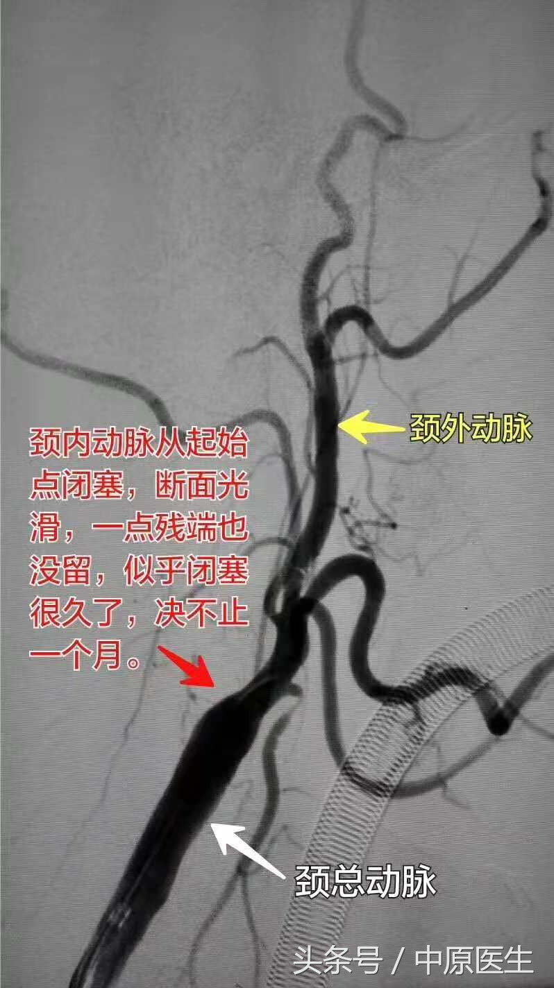 53岁男子脑梗急救室抢救真实纪实,脑动脉闭塞介入治疗视频
