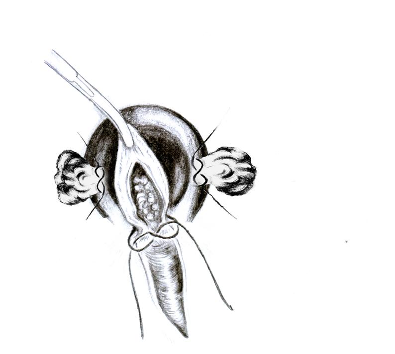 中医肛肠科适宜技术规范,中医肛肠疗法大全