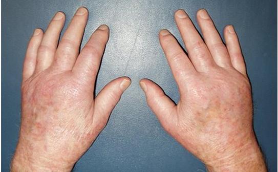 肌肉骨骼疾病的表现是什么,出现骨头疼会是癌吗