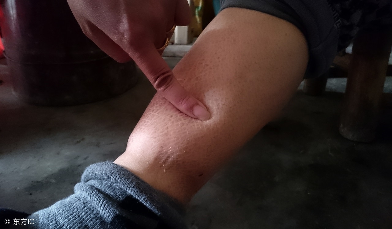 四个征兆暗示你的肝脏好转,这些症状要警惕肝脏病