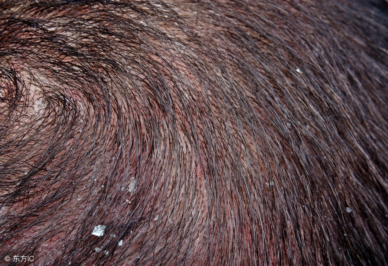 冬天头皮干用什么好用,头皮冬季干燥补水的最佳方法