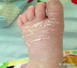 婴儿尿布湿疹的最快自愈方法,婴儿湿疹痤疮尿布疹