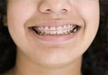 青春期如何把牙变白,青春期怎么让五官变好