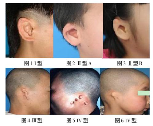 余文林：什么是耳畸形？耳畸形的矫正方法