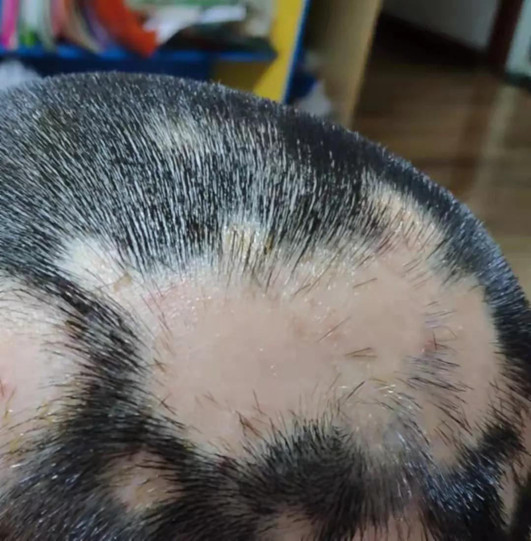 斑秃属于疑难杂症么,斑秃治疗中越来越严重怎么回事