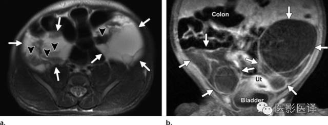 孕期发现卵巢囊肿有8cm左右,孕19周查出胎儿卵巢囊肿