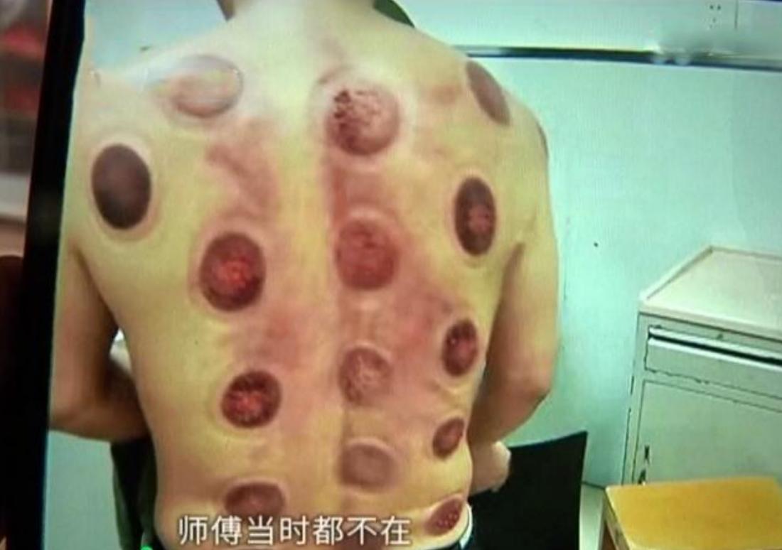 在洗浴中心拔罐后背痒,洗浴中心洗澡后身上痒