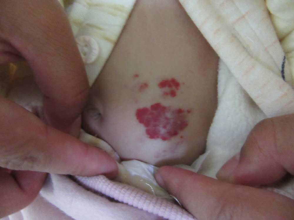 草莓状血管瘤注意事项,草莓状血管瘤婴儿什么时候能自愈