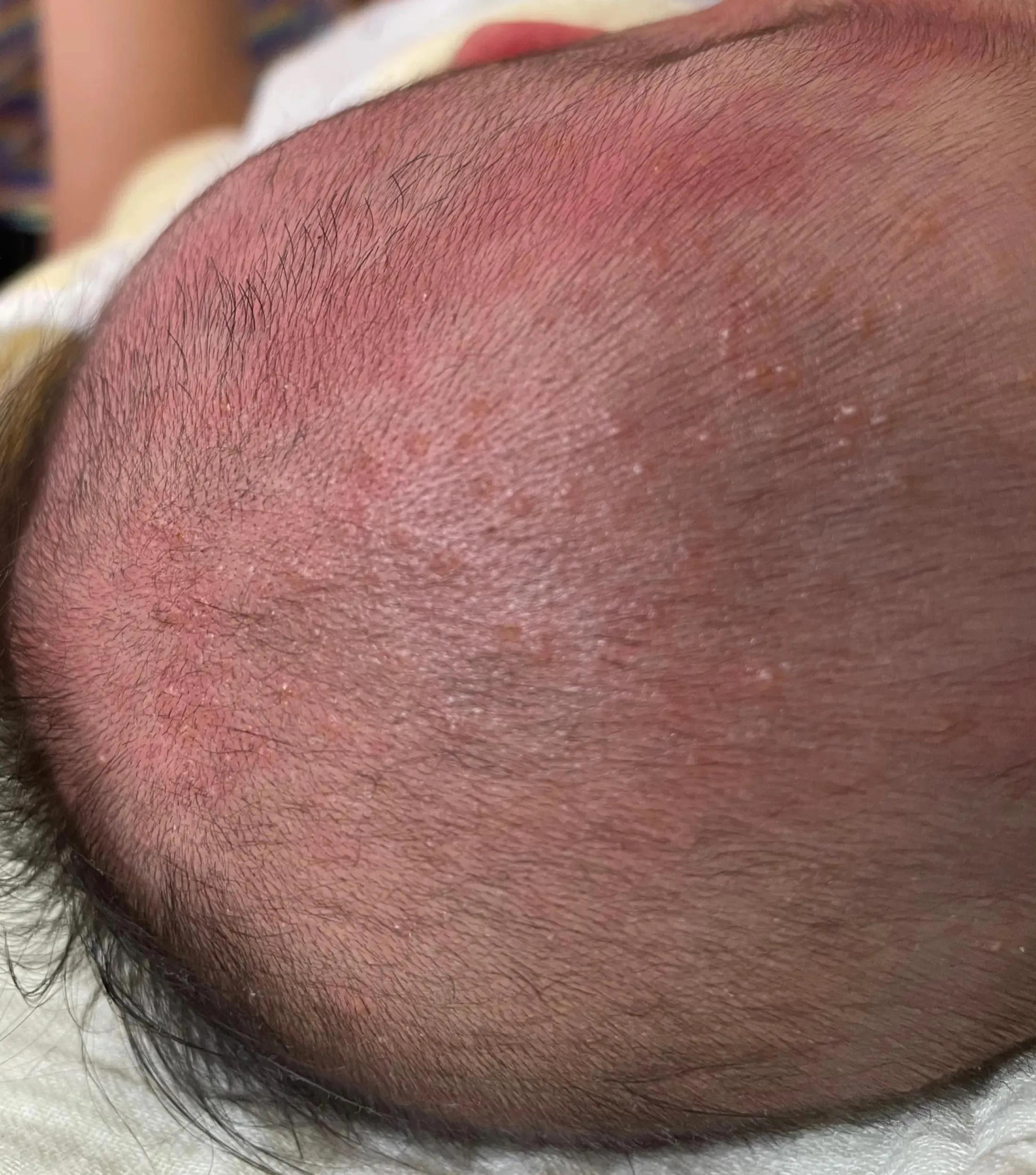 养宠物会不会造成孩子湿疹,宝宝湿疹跟家里养宠物有关系吗