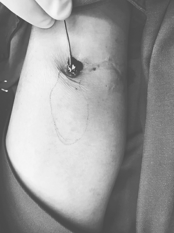 手臂肌肉流脓,胳膊肘流血流脓