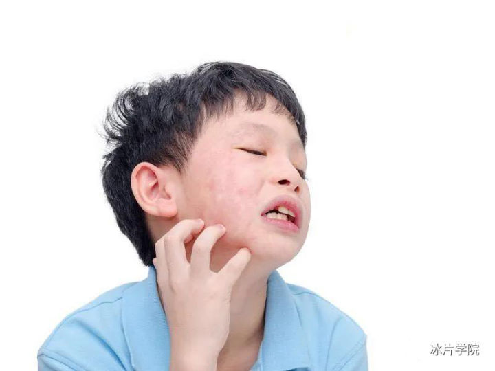 皮肤红痒长小闭口粉刺,脸上长粉刺螨虫能用硫磺软膏吗