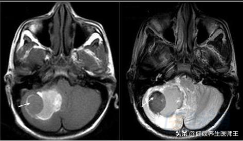 脑出血生命之缘,生命缘脑出血纪录片