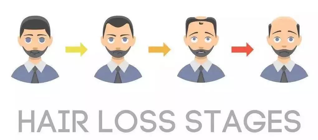 m型发际线秃了几年还能长出来吗,m型发际线会继续脱发嘛