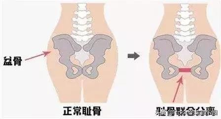 从开始怀孕到产后的心酸,有人从怀孕一个月就开始耻骨痛