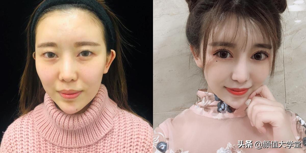 为什么做了双眼皮还不好看,做双眼皮前问清楚自己这三个问题