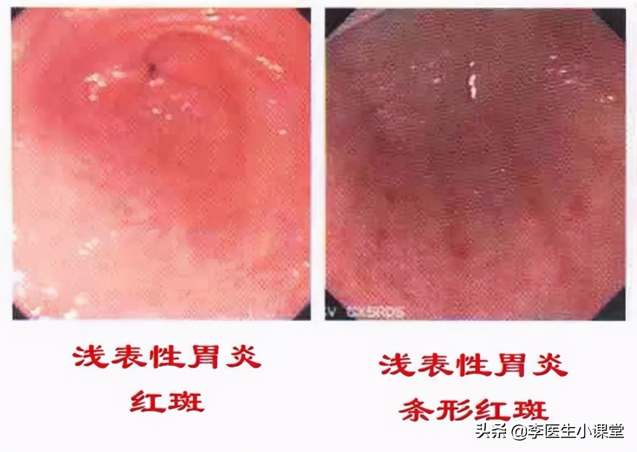 患胃癌前会经历两阶段！在第一阶段改善胃环境，便可逆转癌前疾病