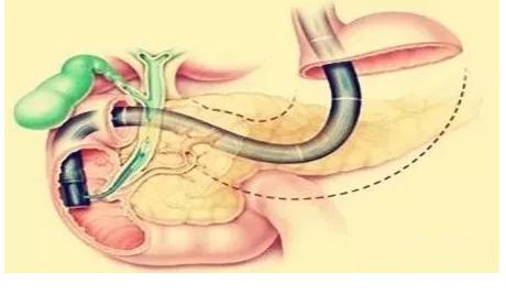 术后败血症肝脓肿住院427天诉讼6年，怎样保障肝胆患者安全（一）
